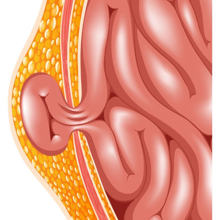 laparoscopic hernia surgery