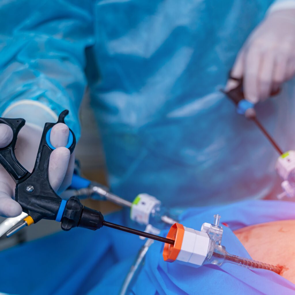 Robotic Fundoplication Surgery Robotic Nissen Fundoplication Surgery r. Shrikant Kurhade