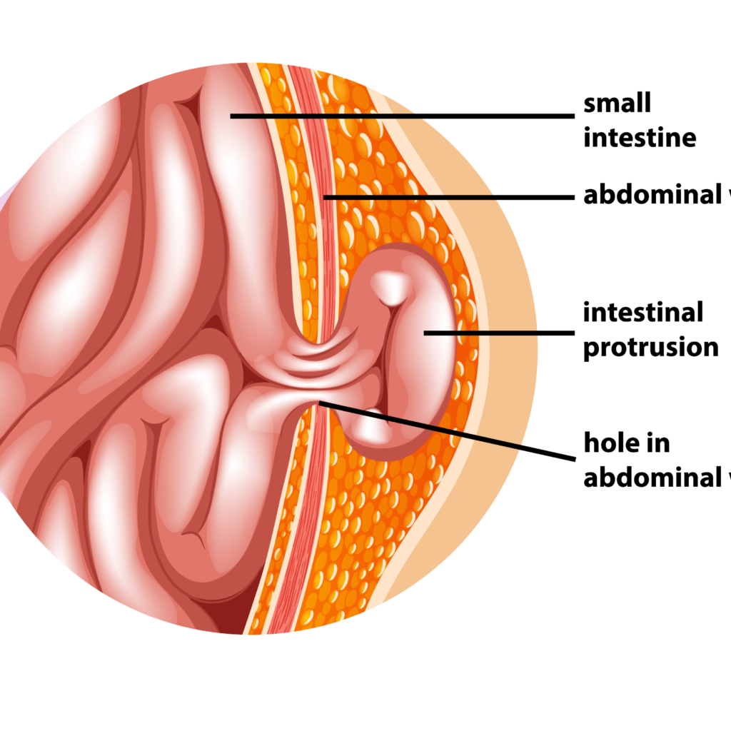 Hernia Treatment In Pune