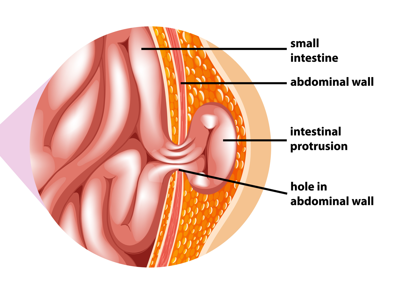 Hernia Treatment In Pune