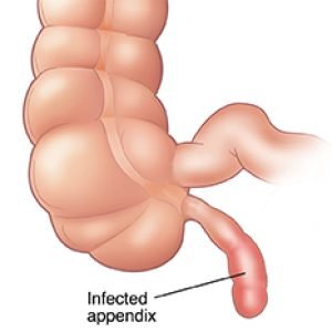 appendicitis surgery in pune