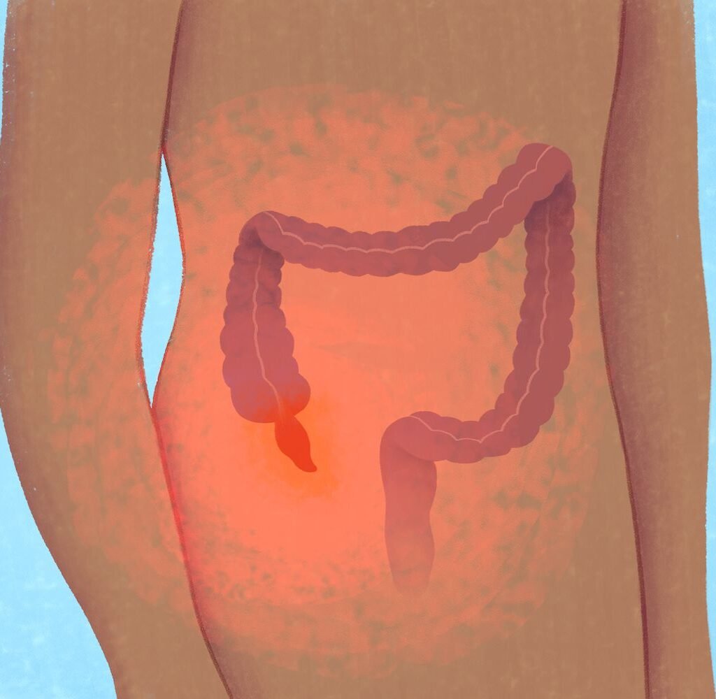 appendix treatment in pune