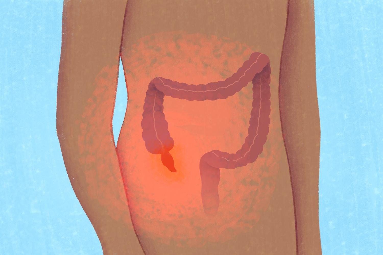 appendix treatment in pune