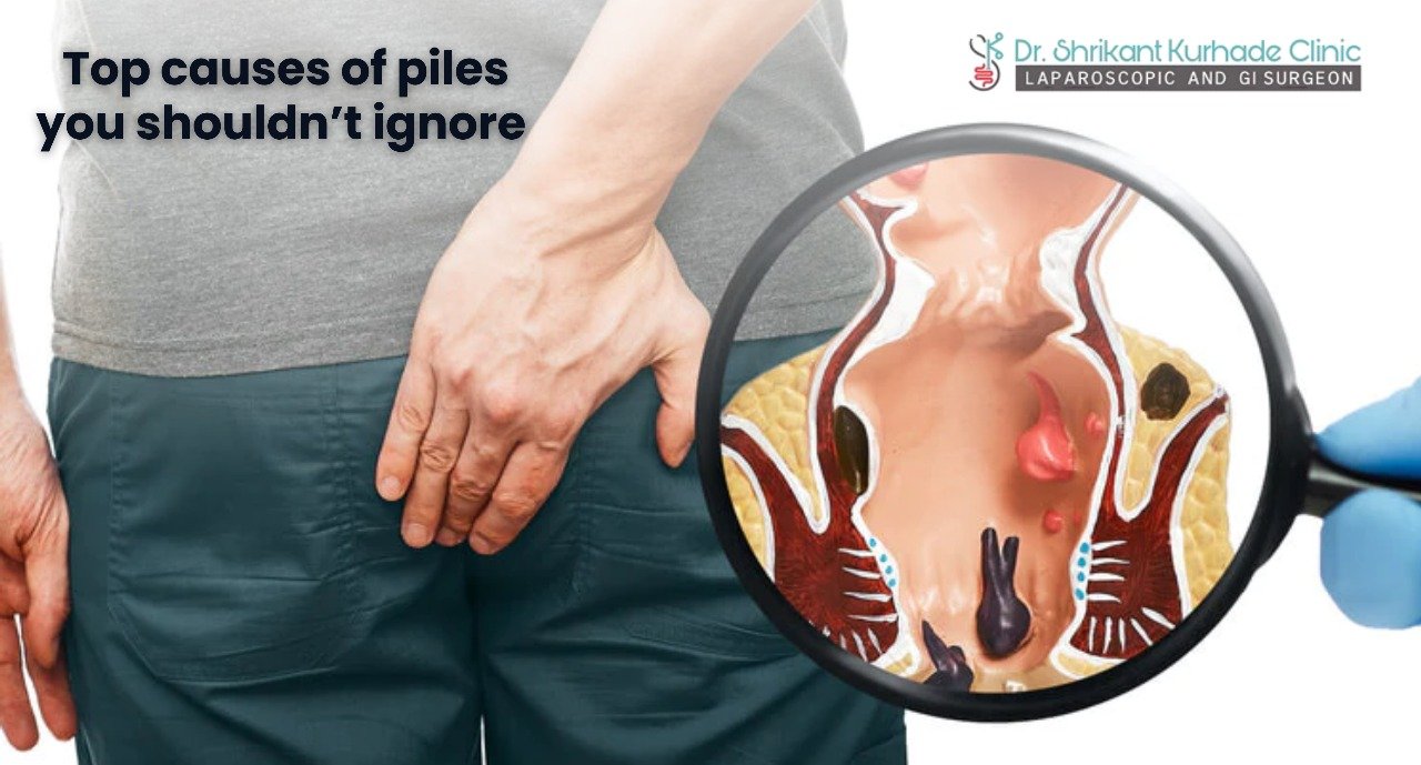 Piles Rypes Top Causes of Piles You Shouldn’t Ignore - Dr Shrikant Kurhade