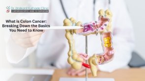 Doctor explaining colon cancer basics