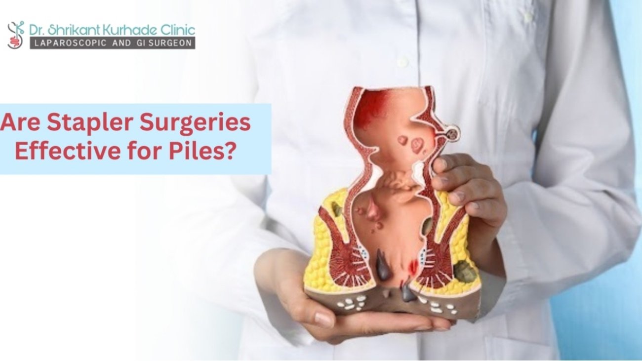 stapler piles surgery