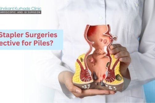 stapler piles surgery
