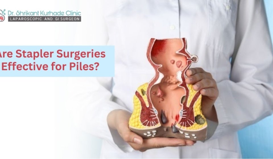 stapler piles surgery