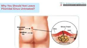 untreated polonidal sinus