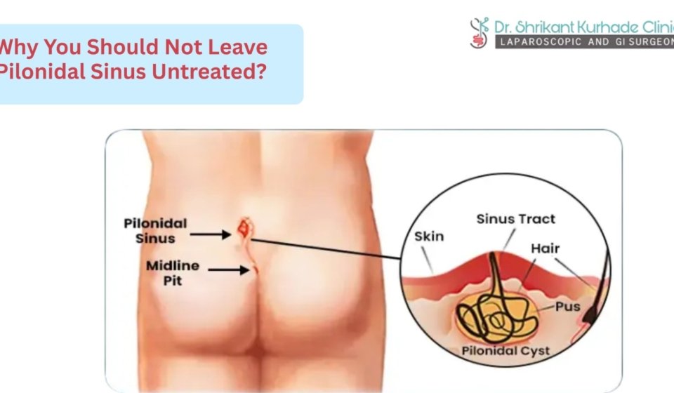 untreated polonidal sinus