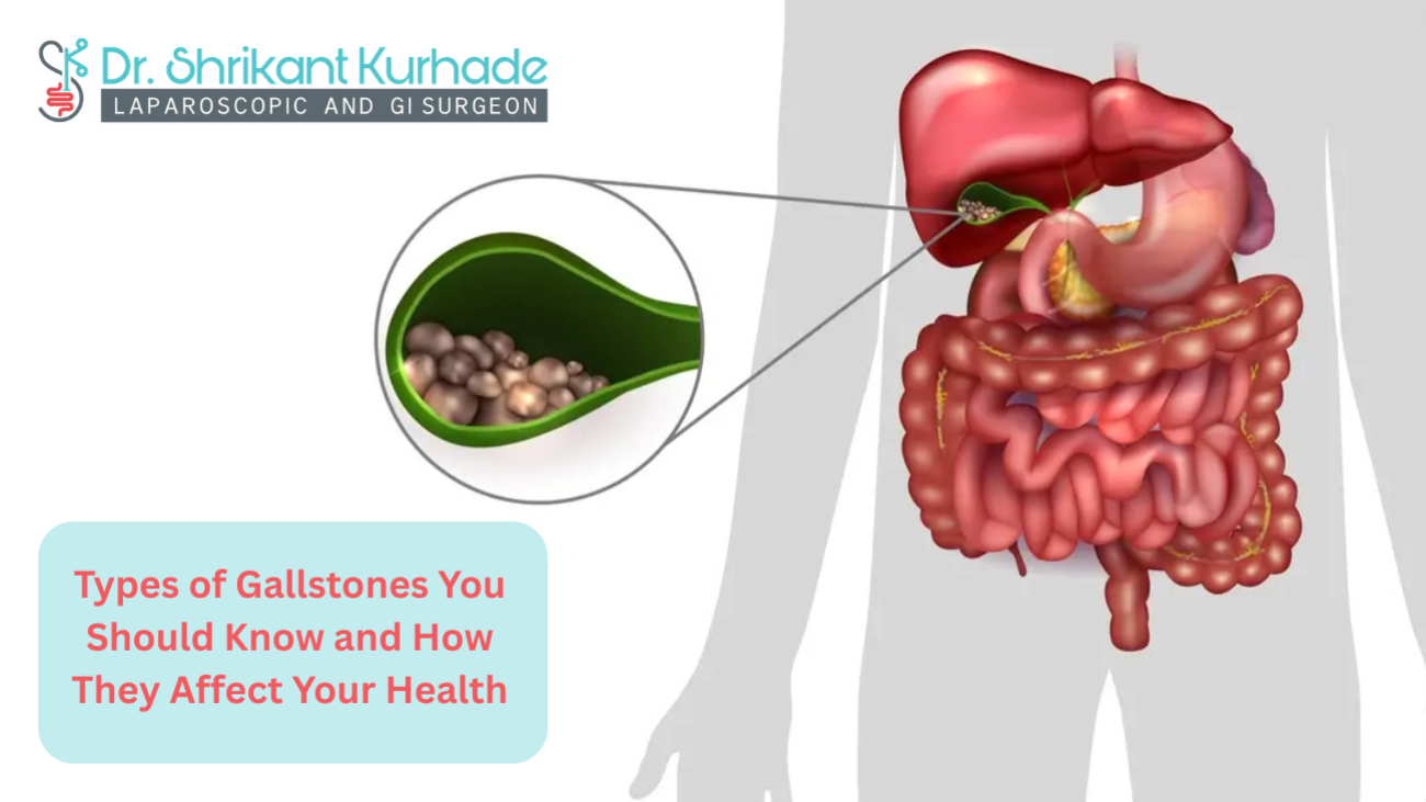 Types of Gallstones