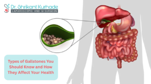 Types of Gallstones
