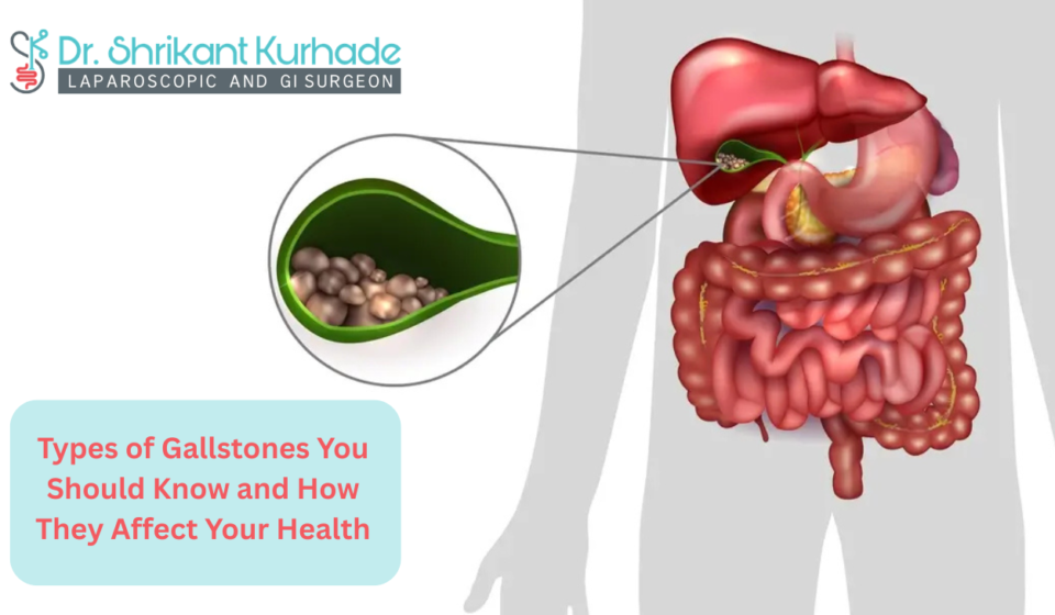 Types of Gallstones